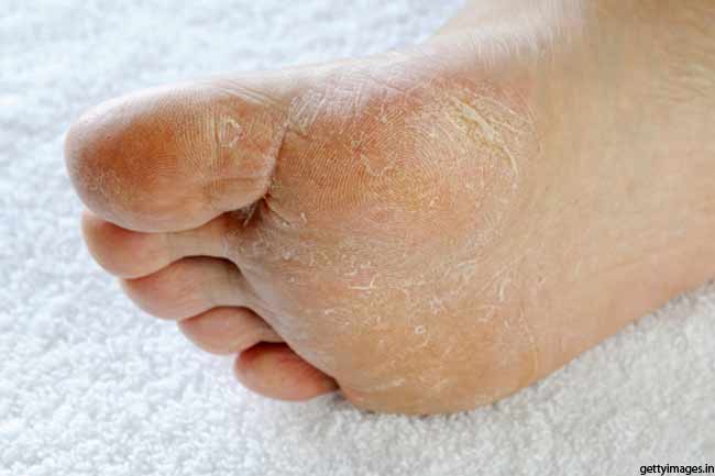 बैक्टीरियल या फंगल संक्रमण से बचाव